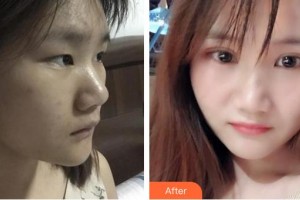 昭通愛麗諾醫(yī)療美容門診部祝向東整形價(jià)格表附開內(nèi)眼角案例展示