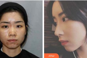 昭通瑪麗婦產(chǎn)醫(yī)院整形美容科李廷勛整形價(jià)格表附鼻部綜合案例展示