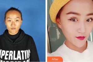 臨滄光明眼科醫(yī)院廖晴國(guó)整形價(jià)格表附切開雙眼皮案例展示