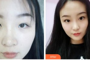 河南省立眼科醫(yī)院祝磊整形價(jià)格表附眼部綜合案例展示