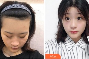 武漢市中心醫(yī)院醫(yī)療美容門診部康夢實整形價格表附植發(fā)案例展示