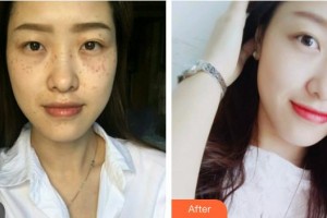 江蘇省人民醫(yī)院整形燒傷科章宏偉整形價格表附鐳射凈膚案例展示