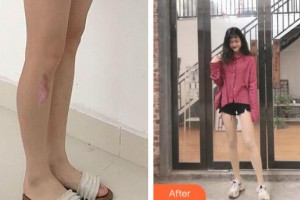 江蘇省蘇北人民醫(yī)院整形美容中心劉亦峰整形價格表附激光祛疤案例展示