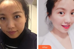 江蘇省蘇北人民醫(yī)院整形美容中心李平松整形價格表附微針美膚案例展示