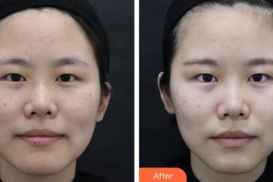 江蘇省蘇北人民醫(yī)院整形美容中心侯團結(jié)整形價格表附激光祛斑案例展示