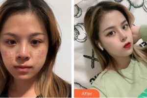 江蘇省蘇北人民醫(yī)院整形美容中心劉森整形價格表附微創(chuàng)疤痕修復案例展示