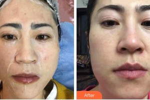 江蘇省人民醫(yī)院整形燒傷科姚剛整形價格表附白瓷娃娃案例展示