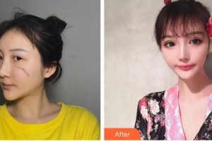 江蘇盛澤醫(yī)院醫(yī)學整形美容中心胡寅整形價格表附激光祛疤案例展示