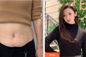 江蘇省人民醫(yī)院整形燒傷科湯建平整形價格表附祛妊娠紋案例展示