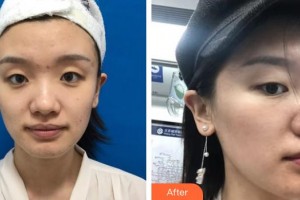 江蘇省蘇北人民醫(yī)院整形美容中心施澤宏整形價格表附去痘印痘坑案例展示