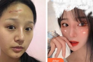 江蘇省人民醫(yī)院整形燒傷科王立夫整形價格表附激光祛疤案例展示