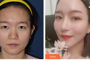 江蘇省人民醫(yī)院整形燒傷科侯祚瓊整形價格表附鼻部綜合案例展示