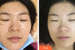 江蘇大學附屬醫(yī)院燒傷整形外科孫炳偉整形價格表附激光點痣】案例展示