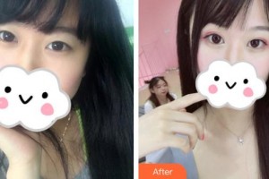 江蘇省人民醫(yī)院整形燒傷科周芳整形價格表附眼部綜合案例展示