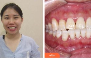 江蘇省口腔醫(yī)院魏昕整形價格表附牙齒隱形矯正案例展示