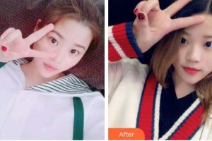 江蘇省人民醫(yī)院整形燒傷科陳默軒整形價格表附冷光美白案例展示