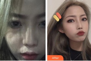 江蘇省人民醫(yī)院整形燒傷科史京萍整形價格表附清潔祛痘案例展示