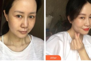 江蘇大學附屬醫(yī)院燒傷整形外科劉昌整形價格表附激光祛斑案例展示