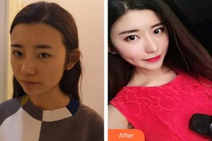 江蘇省蘇北人民醫(yī)院整形美容中心陳嘯整形價格表附黑臉娃娃案例展示