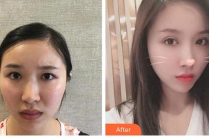 江蘇盛澤醫(yī)院醫(yī)學整形美容中心馬來祥整形價格表附開外眼角案例展示