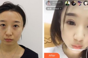 河北醫(yī)科大學(xué)第三醫(yī)院燒傷整形外科曹莫整形價(jià)格表附眼部綜合案例展示