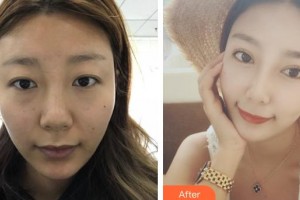 河北省中醫(yī)院醫(yī)療美容科羅磊整形價(jià)格表附眼部綜合案例展示