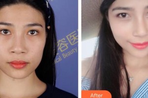 河北工程大學(xué)附屬醫(yī)院整形美容科袁好軍整形價(jià)格表附鼻部綜合案例展示