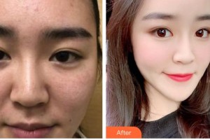 石家莊市中心醫(yī)院整形美容科雷云霄整形價(jià)格表附去痘印痘坑案例展示