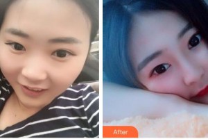 石家莊星源美天醫(yī)療美容醫(yī)院李香梅整形價(jià)格表附隆鼻案例展示