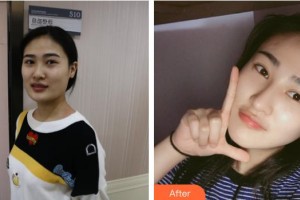 石家莊新興中醫(yī)皮膚病醫(yī)院中醫(yī)美容科楊建國(guó)整形價(jià)格表附光子嫩膚案例展示