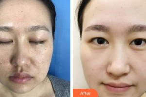 石家莊專家團(tuán)醫(yī)院胎記色斑診療中心王玉國(guó)整形價(jià)格表附激光點(diǎn)痣案例展示