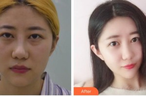 石家莊美萊醫(yī)學(xué)美容醫(yī)院李海霞整形價格表附激光去眼袋案例展示