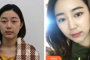 石家莊巍名仕醫(yī)療美容醫(yī)院王麗英整形價格表附切開雙眼皮案例展示