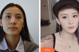 石家莊諾萬醫(yī)療美容醫(yī)院閆風(fēng)芹整形價格表附眼部綜合案例展示