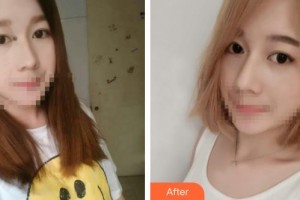 石家莊冀美醫(yī)療美容門診部何曉雅整形價格表附白瓷娃娃案例展示