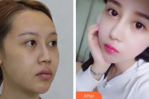 石家莊冀美醫(yī)療美容門診部李娜整形價格表附微針?biāo)獍咐故?>
</a>
<h3 class=