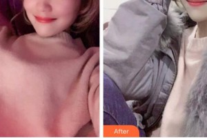 石家莊美萊醫(yī)學(xué)美容醫(yī)院張少民整形價格表附金屬托槽矯正案例展示