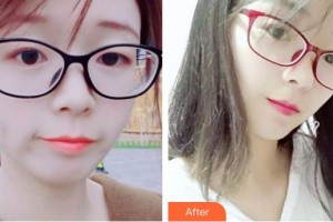 石家莊貴美人醫(yī)療美容醫(yī)院鄒慧嫻整形價格表附微針水光案例展示