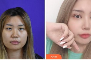 石家莊冀美醫(yī)療美容門診部李芷煥整形價格表附硅膠隆鼻案例展示