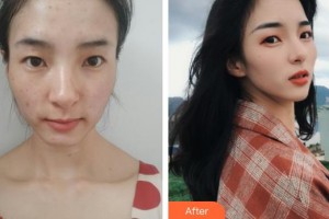 石家莊越然醫(yī)療美容門診部張鴻超整形價格表附激光祛斑案例展示