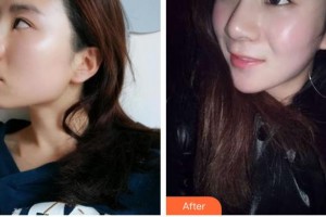 石家莊雅芳亞醫(yī)療美容醫(yī)院馮艷中整形價格表附鼻部綜合案例展示