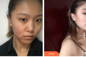 石家莊雅芳亞醫(yī)療美容醫(yī)院吳小玉整形價格表附鼻部綜合案例展示