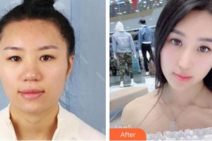 石家莊雅芳亞醫(yī)療美容醫(yī)院張雪梅整形價格表附肋軟骨隆鼻案例展示