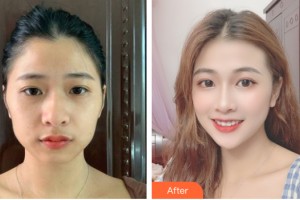 武漢阿芙羅醫(yī)療美容門診部陳建軍整形價(jià)格表附自體脂肪填充案例展示