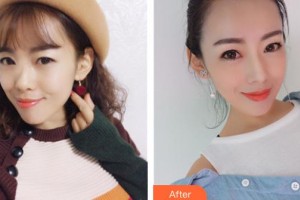 石家莊美萊醫(yī)學美容醫(yī)院田建輝整形價格表附假體隆鼻案例展示