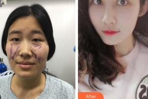 石家莊美萊醫(yī)學美容醫(yī)院姜濤整形價格表附鼻部綜合案例展示