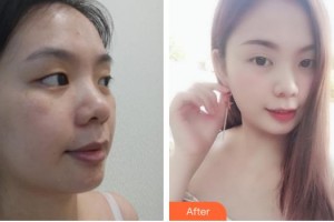 石家莊美萊醫(yī)學美容醫(yī)院李珊珊整形價格表附無針水光案例展示