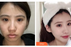 石家莊俏之翼醫(yī)療美容門診部吳志宏整形價格表附激光祛斑案例展示