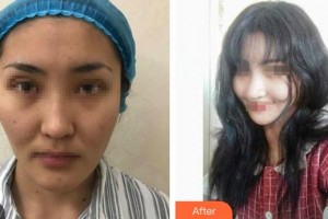 石家莊美萊醫(yī)學美容醫(yī)院張芳整形價格表附鼻部綜合案例展示