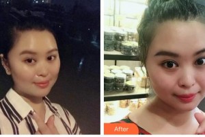 石家莊美萊醫(yī)學(xué)美容醫(yī)院石娟娟整形價(jià)格表附紅藍(lán)光祛痘案例展示